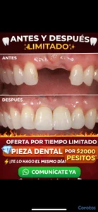 una pieza dental por tan solo 2mil peso y te la hago el mismo día 