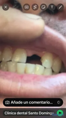 joyas, relojes y accesorios - una pieza dental por tan solo 2mil peso y te la hago el mismo día  5