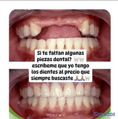 joyas, relojes y accesorios - una pieza dental por tan solo 2mil peso y te la hago el mismo día  6