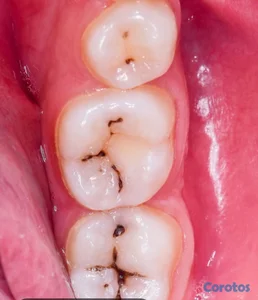 ELIMINACIÓN DE CARIES DENTALES
