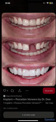 joyas, relojes y accesorios - una pieza dental por tan solo 2mil peso y te la hago el mismo día  3