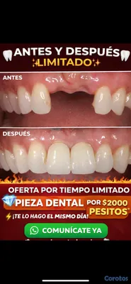 joyas, relojes y accesorios - una pieza dental por tan solo 2mil peso y te la hago el mismo día  2